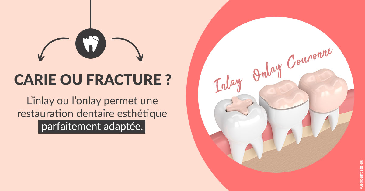 https://dr-marianne-paganon.chirurgiens-dentistes.fr/T2 2023 - Carie ou fracture 2