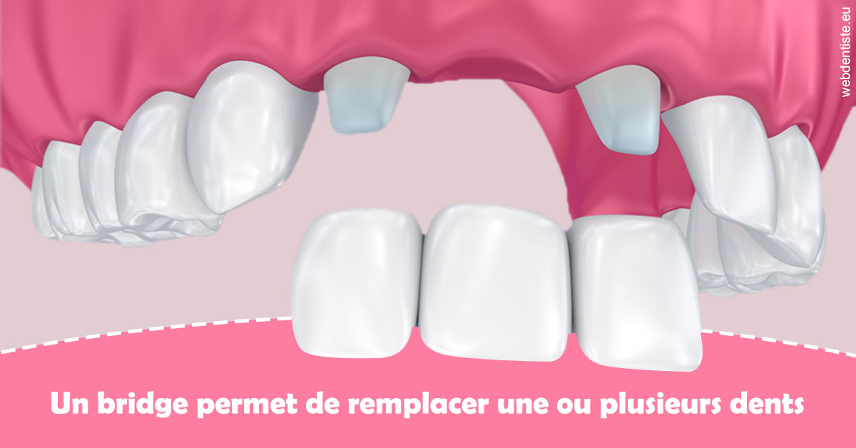 https://dr-marianne-paganon.chirurgiens-dentistes.fr/Bridge remplacer dents 2