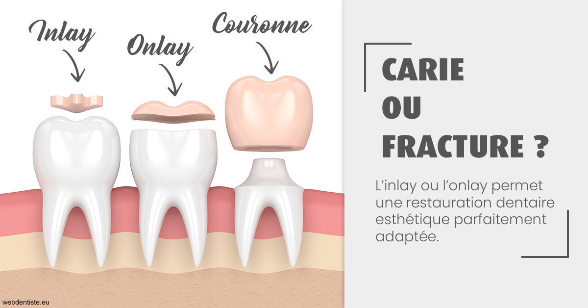 https://dr-marianne-paganon.chirurgiens-dentistes.fr/T2 2023 - Carie ou fracture 1