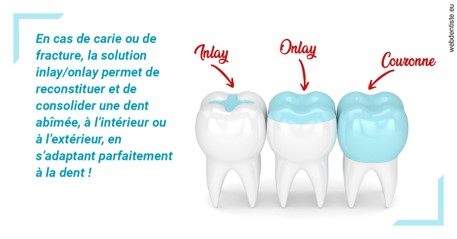 https://dr-marianne-paganon.chirurgiens-dentistes.fr/L'INLAY ou l'ONLAY