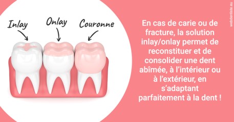https://dr-marianne-paganon.chirurgiens-dentistes.fr/L'INLAY ou l'ONLAY 2