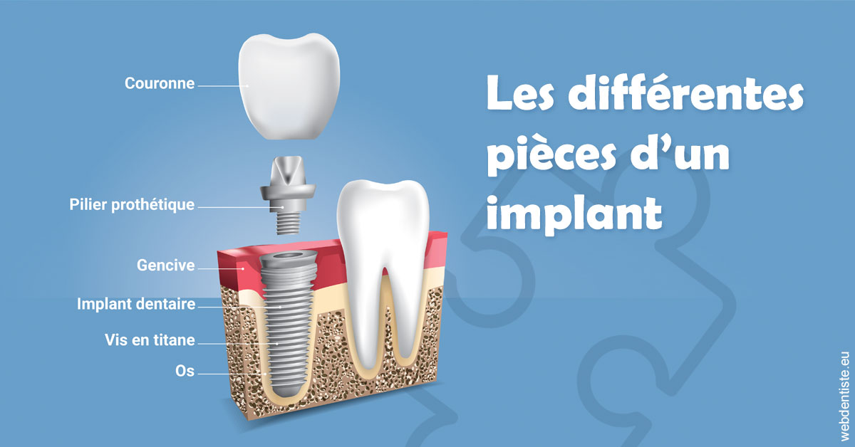 https://dr-marianne-paganon.chirurgiens-dentistes.fr/Les différentes pièces d’un implant 1